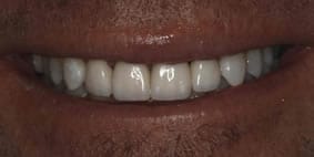 Four porcelain veneers After