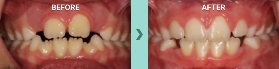 Myobrace before and after