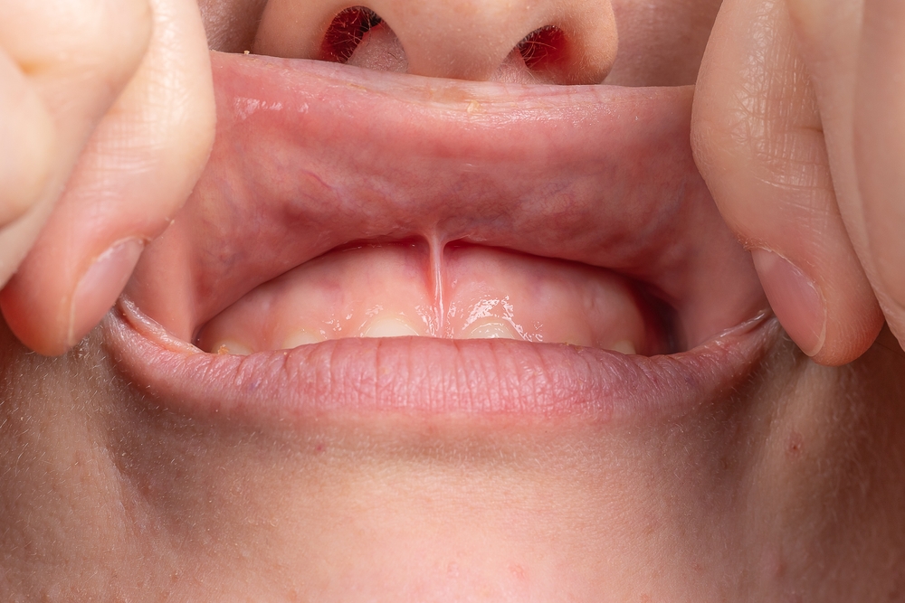 frenectomy boise