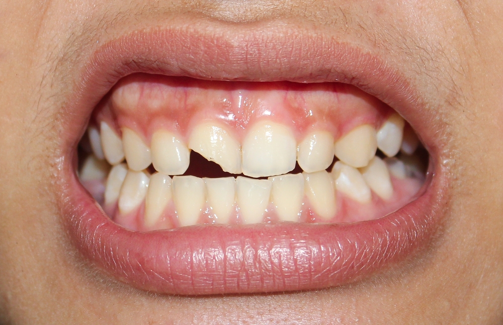 chipped tooth repair